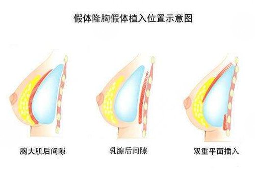 曼托隆胸術(shù)后如何護(hù)理？