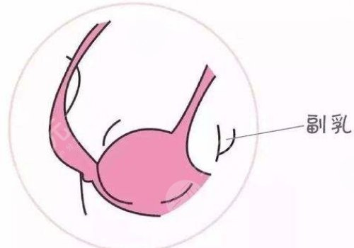 副乳手術(shù)有哪些注意事項?