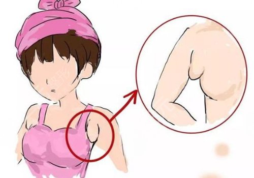 副乳怎么消除快并且有？副乳切除手術(shù)疼不疼？附上這幾點注意事項！