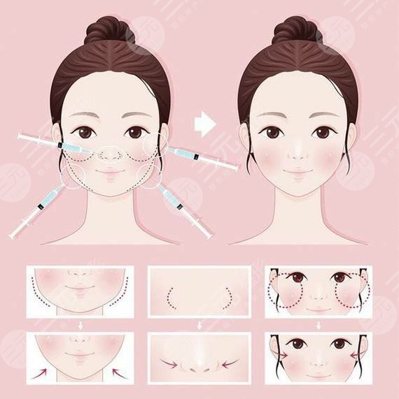 北京金晟麗人醫(yī)療美容診所臉部吸脂案例