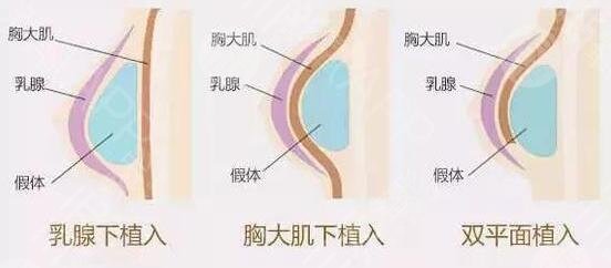 德國寶儷假體價格是多少錢?