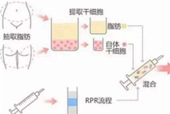 脂肪移植