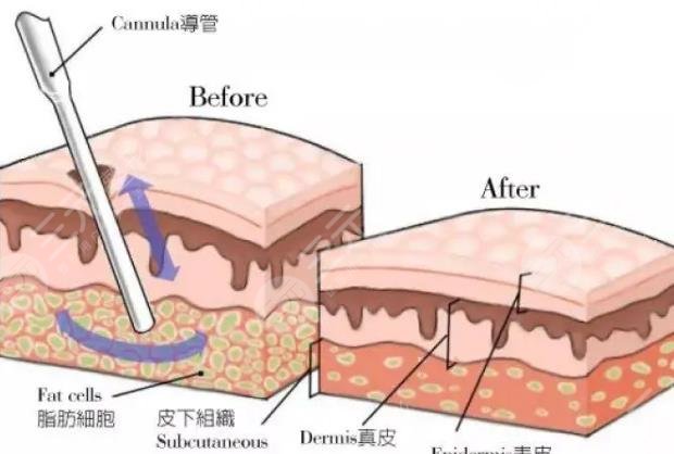 水動力吸脂