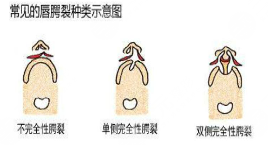唇腭裂鼻子修復(fù)多大年齡合適？唇腭裂修復(fù)過程和時間需要多久？