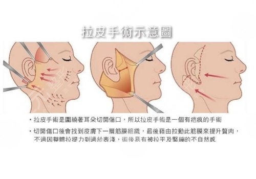 拉皮手術(shù)能維持幾年？這幾種屬于禁忌人群！醫(yī)美抗衰莫盲目~