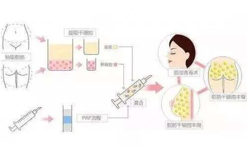 自體脂肪填充太陽(yáng)凹陷能維持多久？多少錢？疼嗎？附價(jià)格表+注意事項(xiàng)