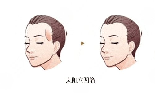 自體脂肪填充太陽(yáng)凹陷能維持多久？多少錢？疼嗎？附價(jià)格表+注意事項(xiàng)