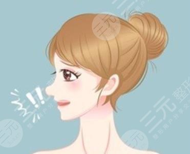 駝峰鼻