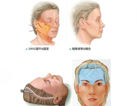 拉皮手術(shù)傷口會不會留疤？疤痕多久消失？手術(shù)注意事項30秒速讀