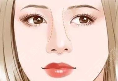 歪鼻矯正