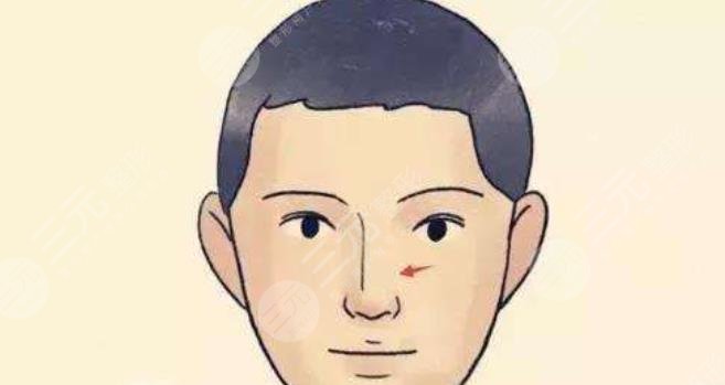 歪鼻矯正