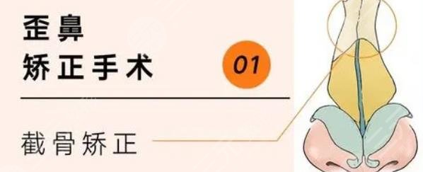 歪鼻矯正