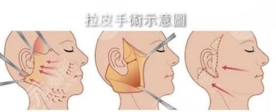 拉皮手術(shù)