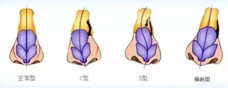 歪鼻矯正