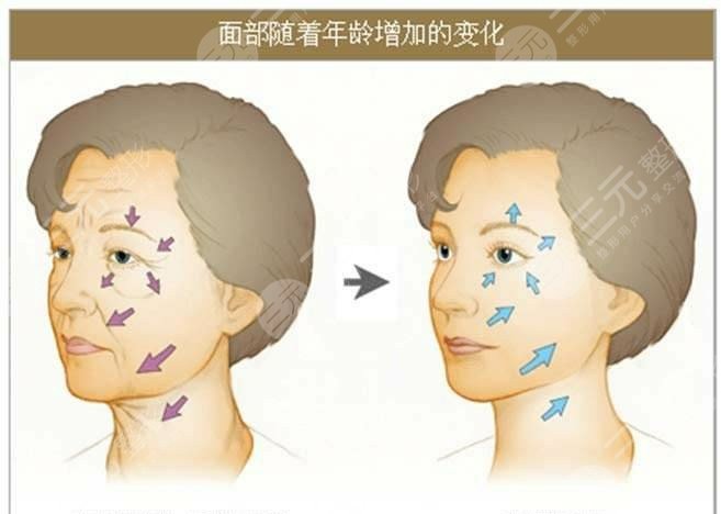 廣州廣美醫(yī)院整形埋線除皺面部