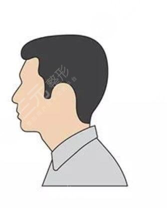 長(zhǎng)沙新生植發(fā)醫(yī)院胡須種植案例分享