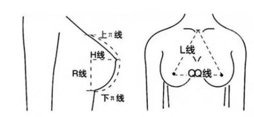 隆胸假體