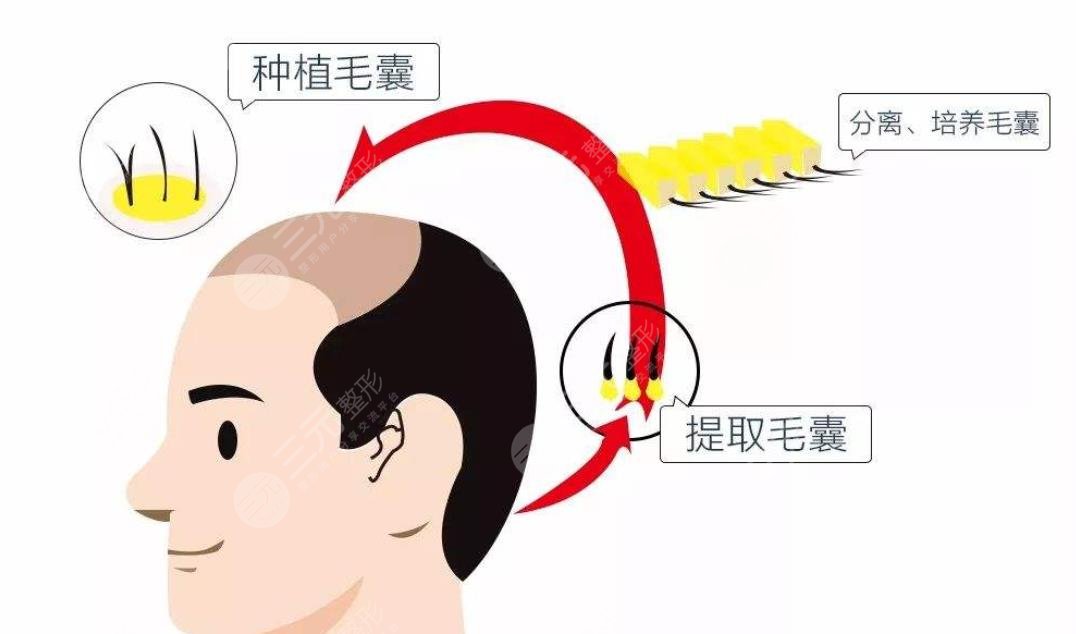 毛發(fā)種植手術(shù)