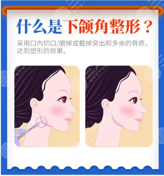 下頜角整形術(shù)有危險(xiǎn)嗎？費(fèi)用大概多少錢？價(jià)格表附上