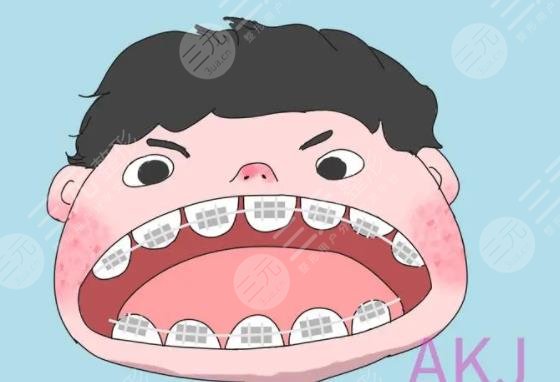 舌側(cè)矯正