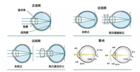 近視眼激光手術(shù)禁忌人群有哪些?
