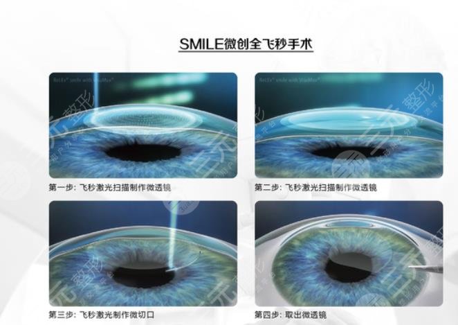 近視眼激光手術(shù)禁忌人群有哪些?