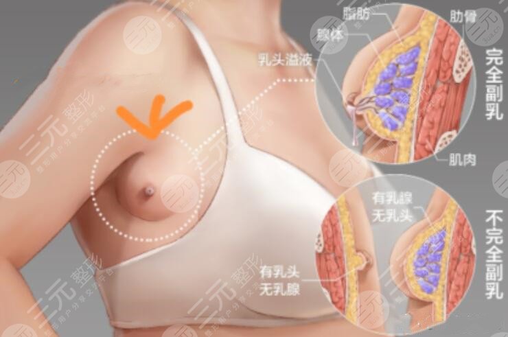 切除副乳對比圖片，真人展示切除副乳術后1個月，她說沒了副乳后終于敢秀身材了~