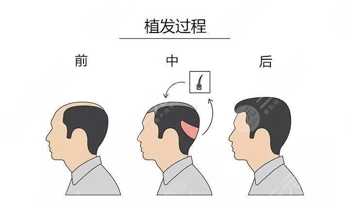 植發(fā)項(xiàng)目相關(guān)科普介紹之M型植發(fā)手術(shù)