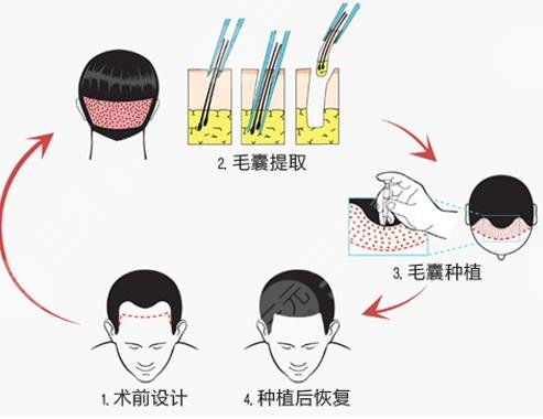深圳植發(fā)多少錢一個(gè)毛囊?