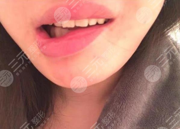 女子整容失敗嘴巴歪，花一年多時間緩解！整形醫(yī)院只退3.5萬手術費！