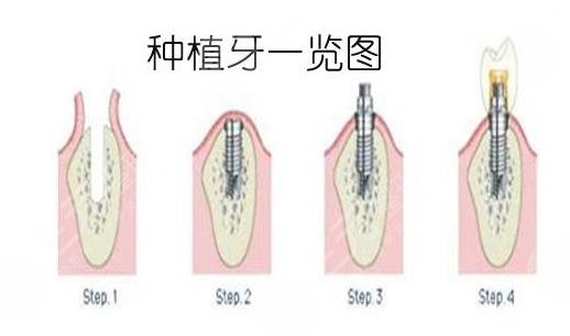種植牙的過(guò)程步驟有幾個(gè)？過(guò)程需要多長(zhǎng)時(shí)間？牙齒種植流程一文解！