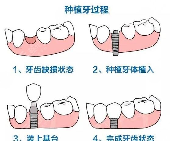 種植牙手術(shù)科普簡介