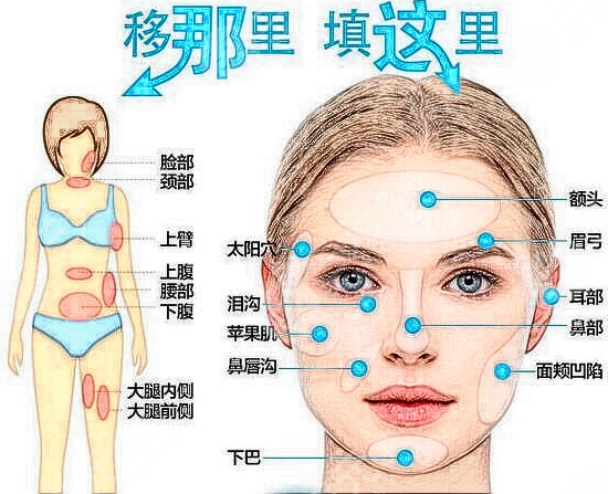 成都自體脂肪面部填充價格多少?費用是多少?