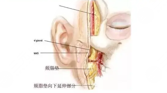 去頰脂墊手術