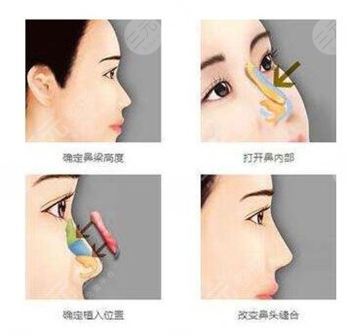 鼻翼缺損修復(fù)手術(shù)的難易程度，手術(shù)大致操作步驟