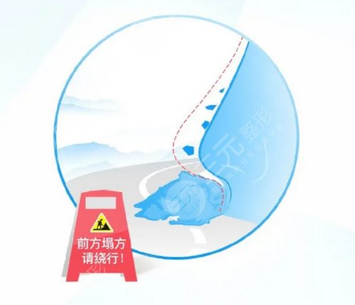 隆鼻手術(shù)有幾種？隆鼻方式歸納匯總！