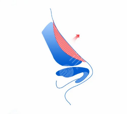 韓式隆鼻