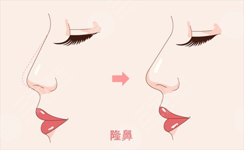 人工骨隆鼻吸收率是多少？手術前后需要注意的事項