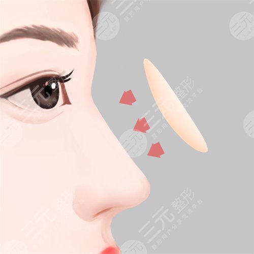 【須知】自體軟骨隆鼻缺點(diǎn)是什么？你能接受嗎？注意事項(xiàng)有哪些？