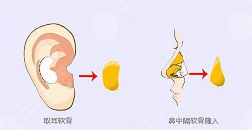 自體軟骨隆鼻注意事項(xiàng)