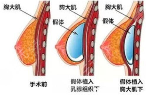 失敗隆胸修復手術(shù)的注意事項
