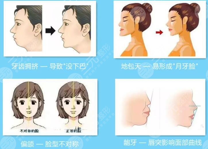 磨骨手術(shù)對(duì)比照片
