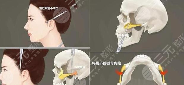 磨骨手術(shù)術(shù)前注意事項(xiàng)