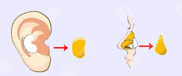 鼻修復