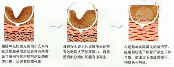 激光祛痘果好嗎?