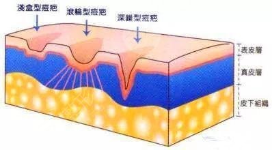激光祛痘后需要注意什么?