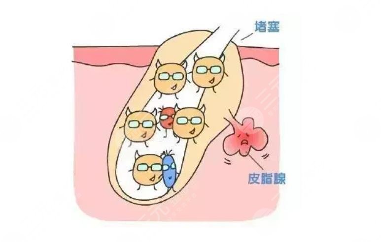 后背長痘痘是什么原因?怎么消除?
