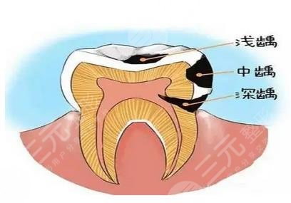 齲齒