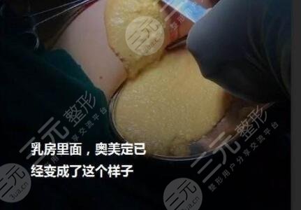 取奧美定可以醫(yī)保報銷嗎？