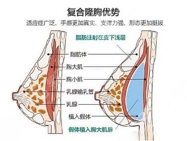 隆胸手術(shù)